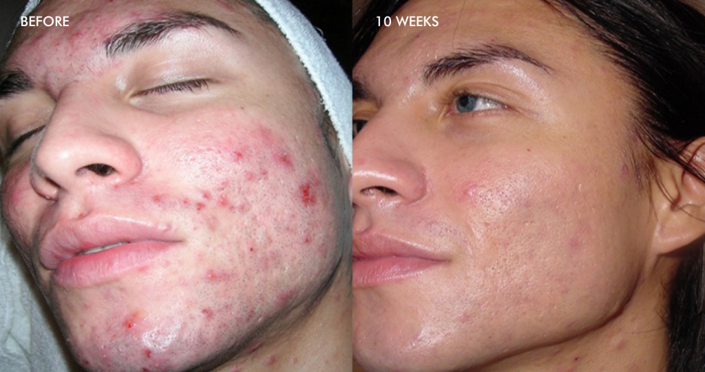 Anewskin Medspa Microneedling for Acne Scars in Washington DC