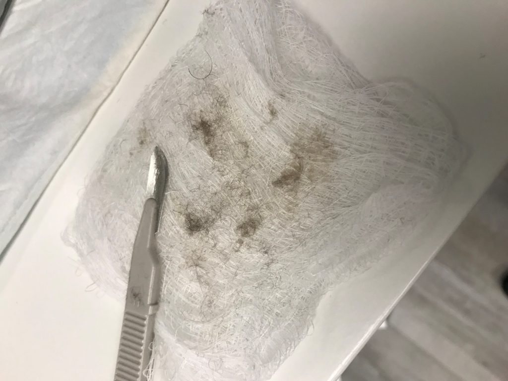 Dead skin cells removed by dermaplaning at AnewSkin Medspa Washington DC