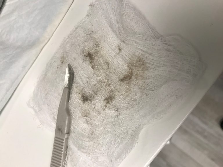 Dead skin cells removed by dermaplaning at AnewSkin Medspa Washington DC
