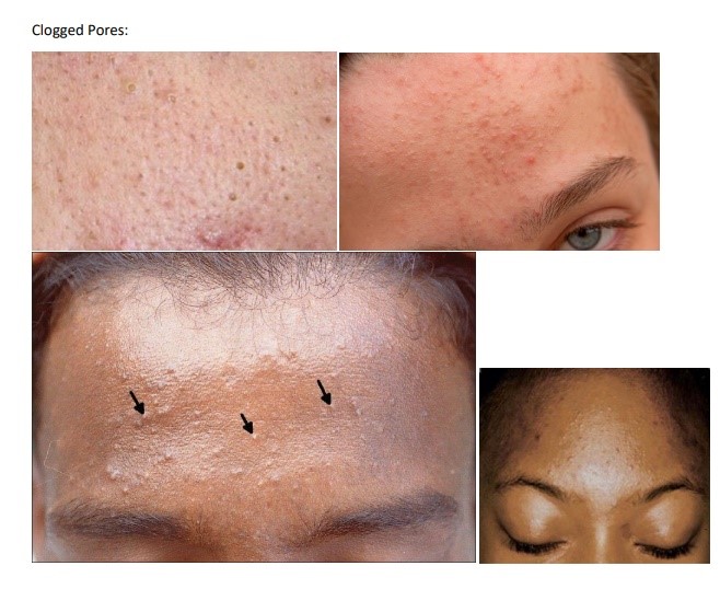 Acne with clogged pores requires specialized treatment.