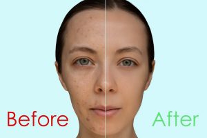 Before/After Chemical peel treatment for acne 