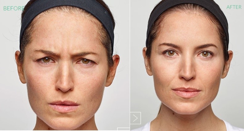 Before/After Dysport Injection to Frown lines.