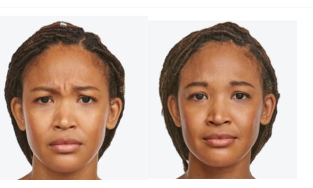 Before/After Jeuveau Injections to Frown Lines