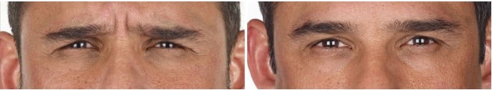 Before/After xeomin injection to frown lines