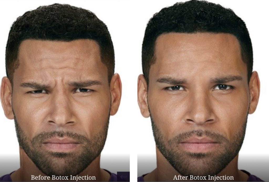Before Botox Injection Vs After Botox Injection at AnewSkin Medspa Before Botox Injection Vs After Botox Injection at AnewSkin Medspa