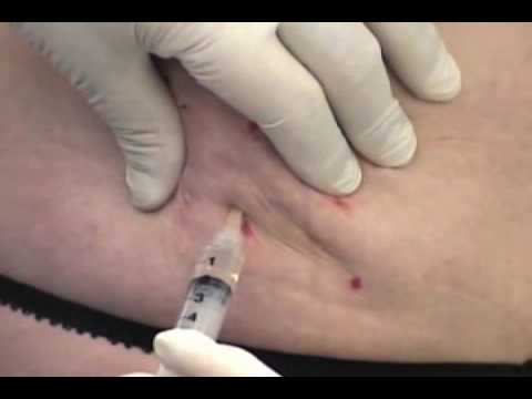 Injection lipolysis