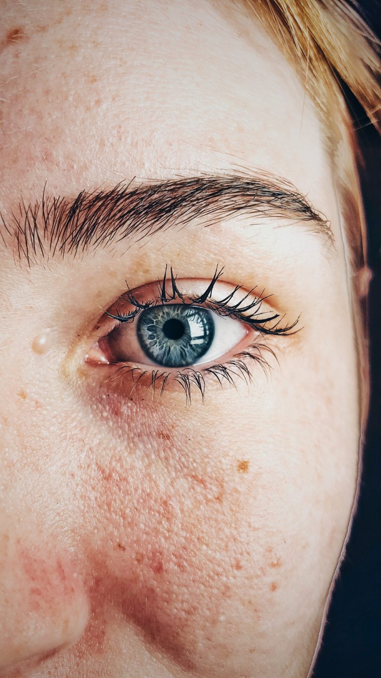 Damaged pores with microneedling