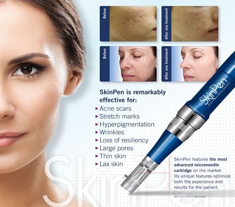 5 Things you need to know about micro-needling