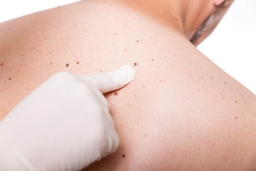 GET RID OF PIGMENTATION SPOTS ON YOUR BODY