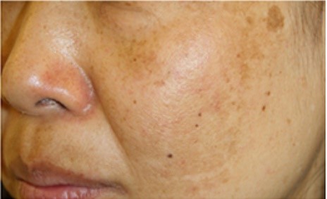 RF-IPL Photofacial
