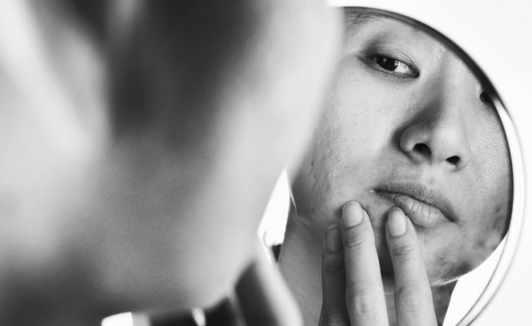 Acne and Mental Health: What is the Physician’s Role?