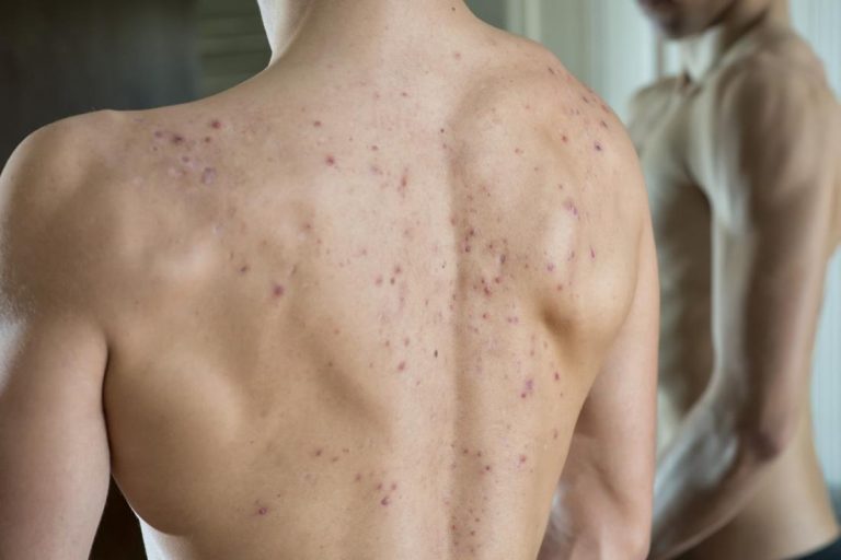 How To Get Rid of Back Acne