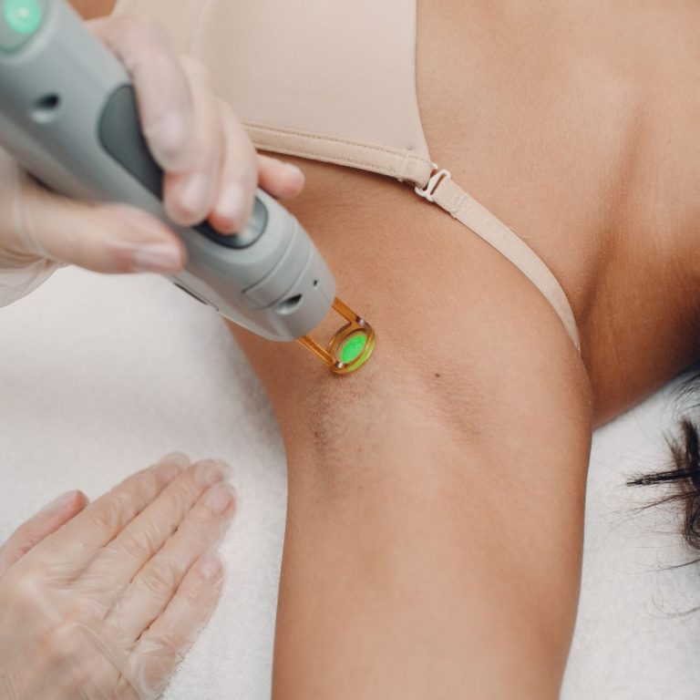 Dark underarms, and how to improve them