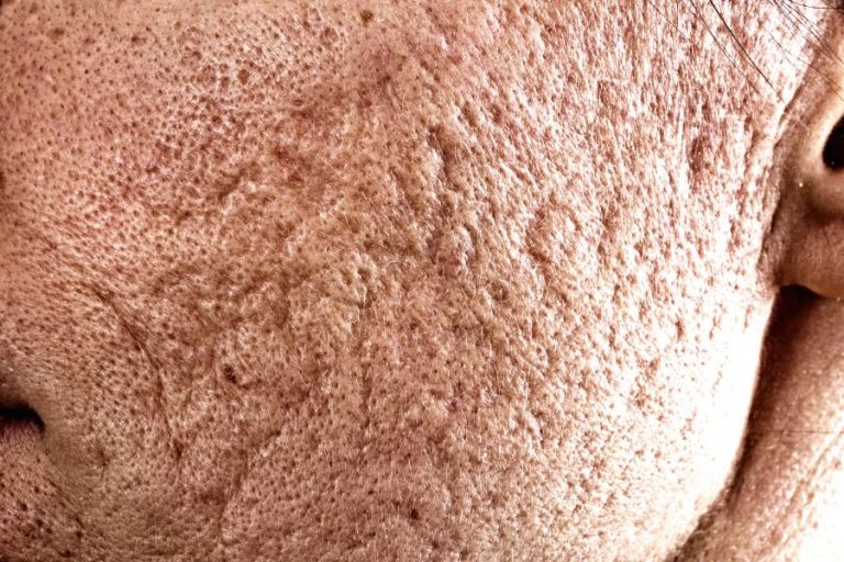 25% TCA Peel and Dermabrasion Significantly Improves Acne Scar Appearance