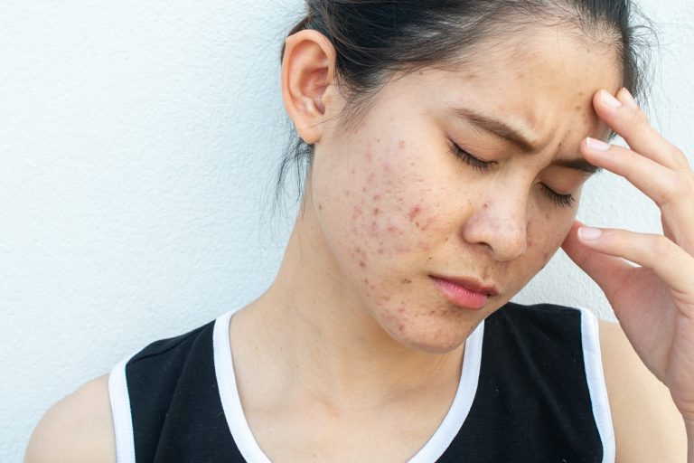 How alpha-hydroxy acids and beta-hydroxy acids can reduce acne