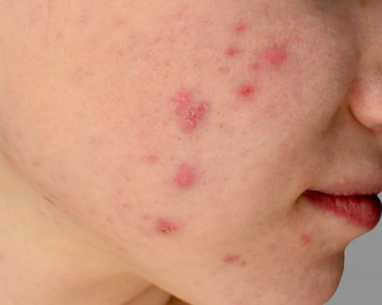 Types of acne & how to treat them all