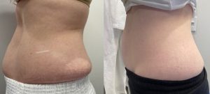 laser body sculpting in DC