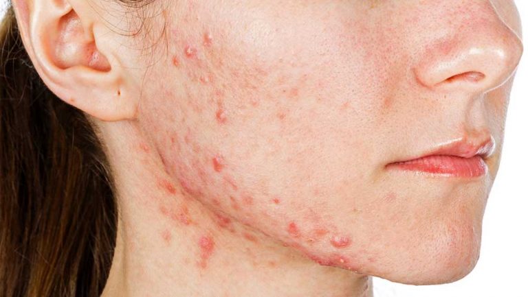 Common skin concerns (Hormonal Acne)