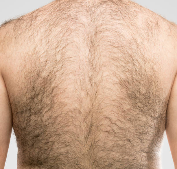 Back Hair Laser Hair Removal!