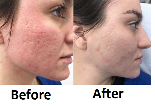 Laser skin resurfacing Before/After