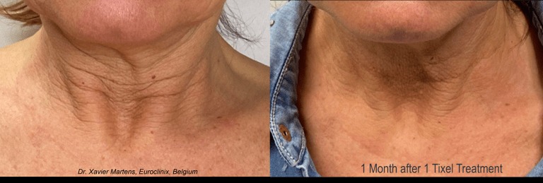 Neck Rejuvenation: