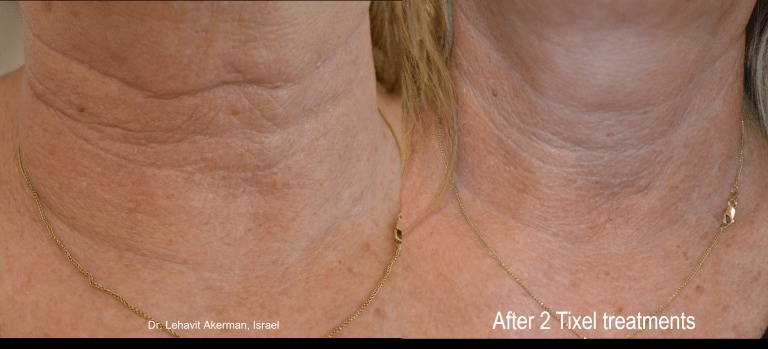 Neck Rejuvenation