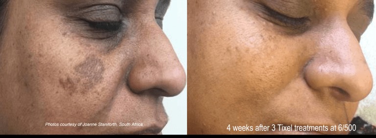 Acne, large pores and hyperpigmentation​