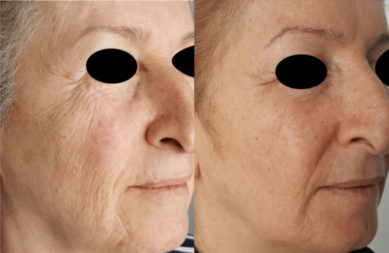 Anti-Aging Skin tightening
