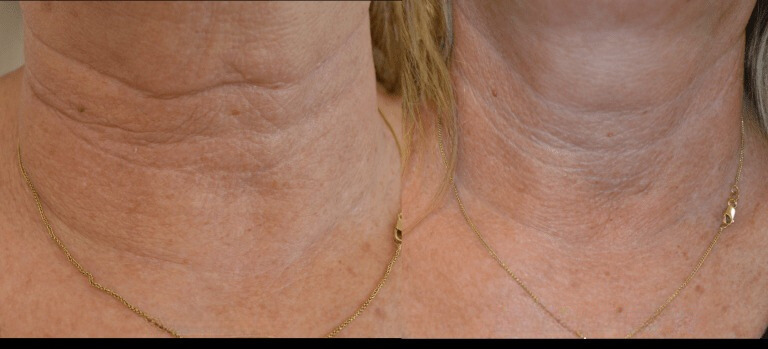 Neck Rejuvenation
