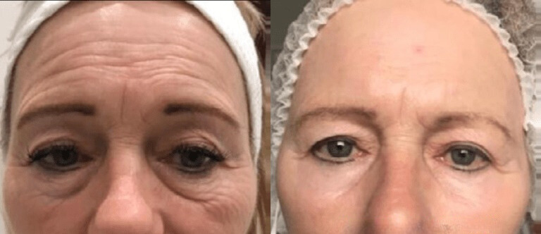 Anti-Aging Skin tightening