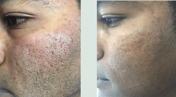 Acne, large pores and hyperpigmentation​