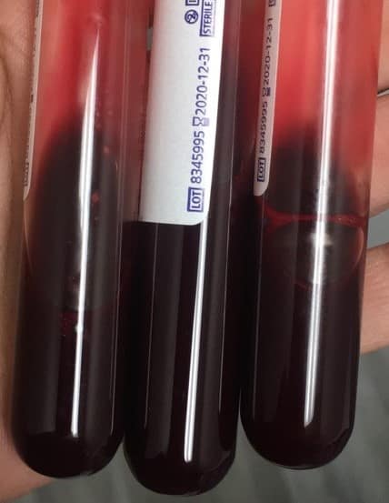 Blood draw for PRP in AnewSkin MedSpa Washington DC
