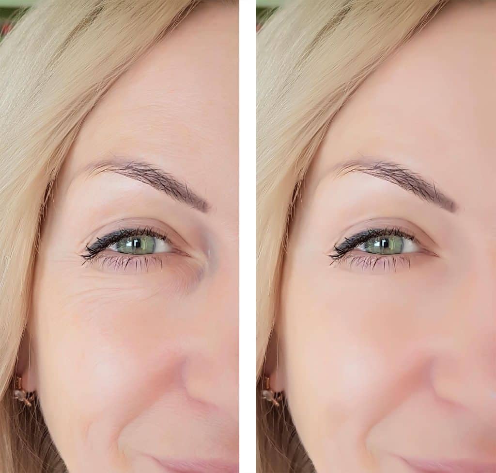face woman wrinkles before and after the forehead botox